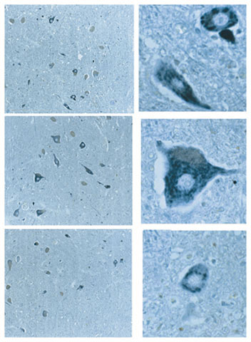 Caspase-9 activation was confirmed in human ALS motoneurons