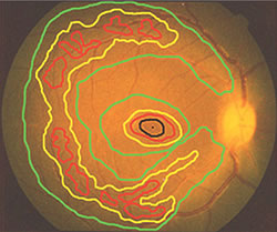 Fig.2: Retinal function map showing the distribution of photoreceptor cell activity