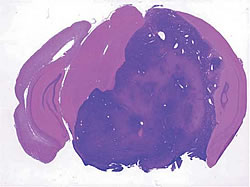 図3：ソニックヘッジホッグシグナルの異常による脳腫瘍
